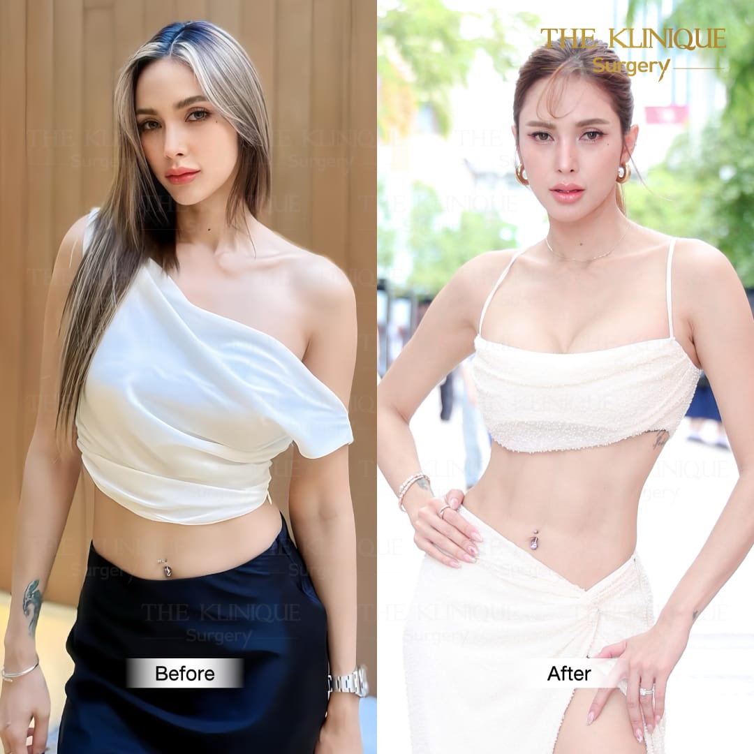 Liposuction, Sculpting,Xshape,Lipo, ศัลยกรรมดูดไขมัน, ดูดไขมัน,คลินิกดูดไขมัน,ดูดไขมันเฉพาะส่วน,ดูดไขมันเหนียง,ดูดไขมันหน้าท้อง,รีวิวดูดไขมัน, รีวิวดูดไขมันหน้าท้อง,ดูดไขมันต้นแขน, ดูดไขมันต้นขา,ลดความอ้วน, ดูดไขมันที่ไหนดี, ดูดไขมันราคา
