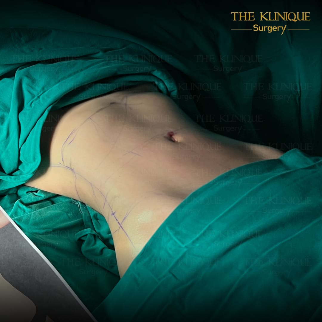 Liposuction, Sculpting,Xshape,Lipo, ศัลยกรรมดูดไขมัน, ดูดไขมัน,คลินิกดูดไขมัน,ดูดไขมันเฉพาะส่วน,ดูดไขมันเหนียง,ดูดไขมันหน้าท้อง,รีวิวดูดไขมัน, รีวิวดูดไขมันหน้าท้อง,ดูดไขมันต้นแขน, ดูดไขมันต้นขา,ลดความอ้วน, ดูดไขมันที่ไหนดี, ดูดไขมันราคา