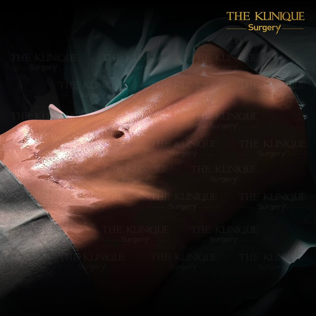 Liposuction, Sculpting,Xshape,Lipo, ศัลยกรรมดูดไขมัน, ดูดไขมัน,คลินิกดูดไขมัน,ดูดไขมันเฉพาะส่วน,ดูดไขมันเหนียง,ดูดไขมันหน้าท้อง,รีวิวดูดไขมัน, รีวิวดูดไขมันหน้าท้อง,ดูดไขมันต้นแขน, ดูดไขมันต้นขา,ลดความอ้วน, ดูดไขมันที่ไหนดี, ดูดไขมันราคา