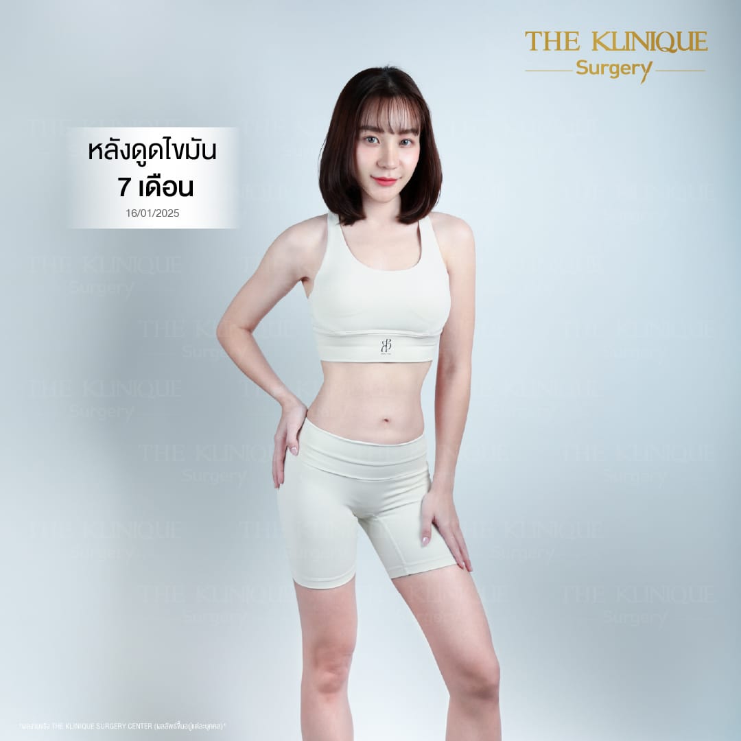 Liposuction_BodyContouring_11Lines