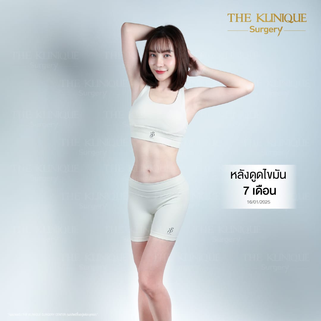 Liposuction_BodyContouring_11Lines