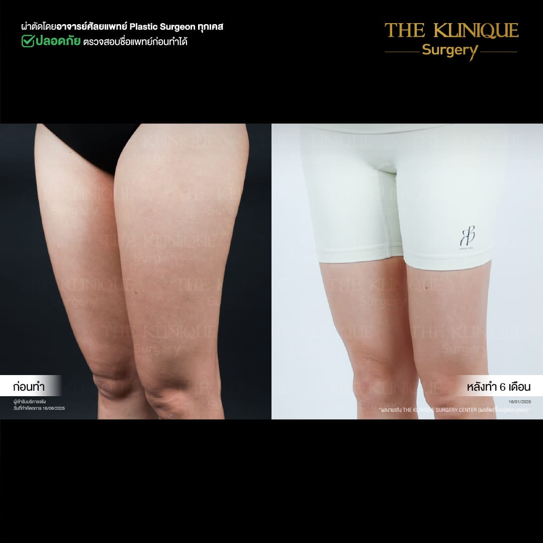 Liposuction_BodyContouring_11Lines