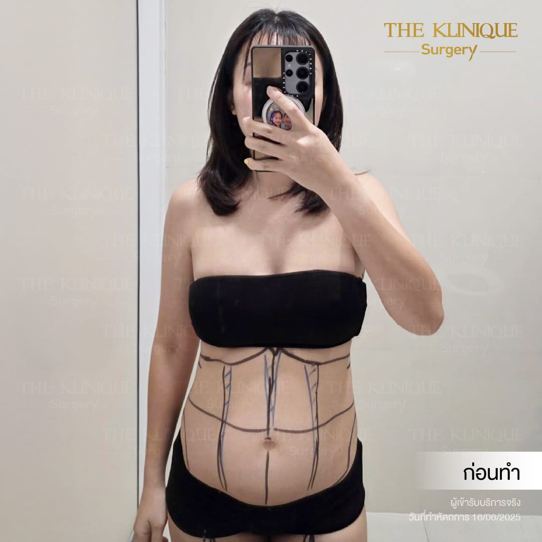 Liposuction_BodyContouring_11Lines