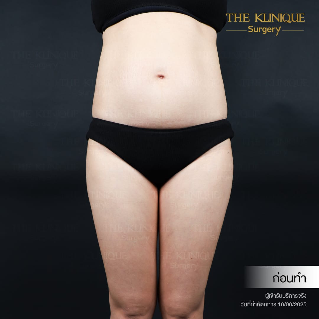 Liposuction_BodyContouring_11Lines