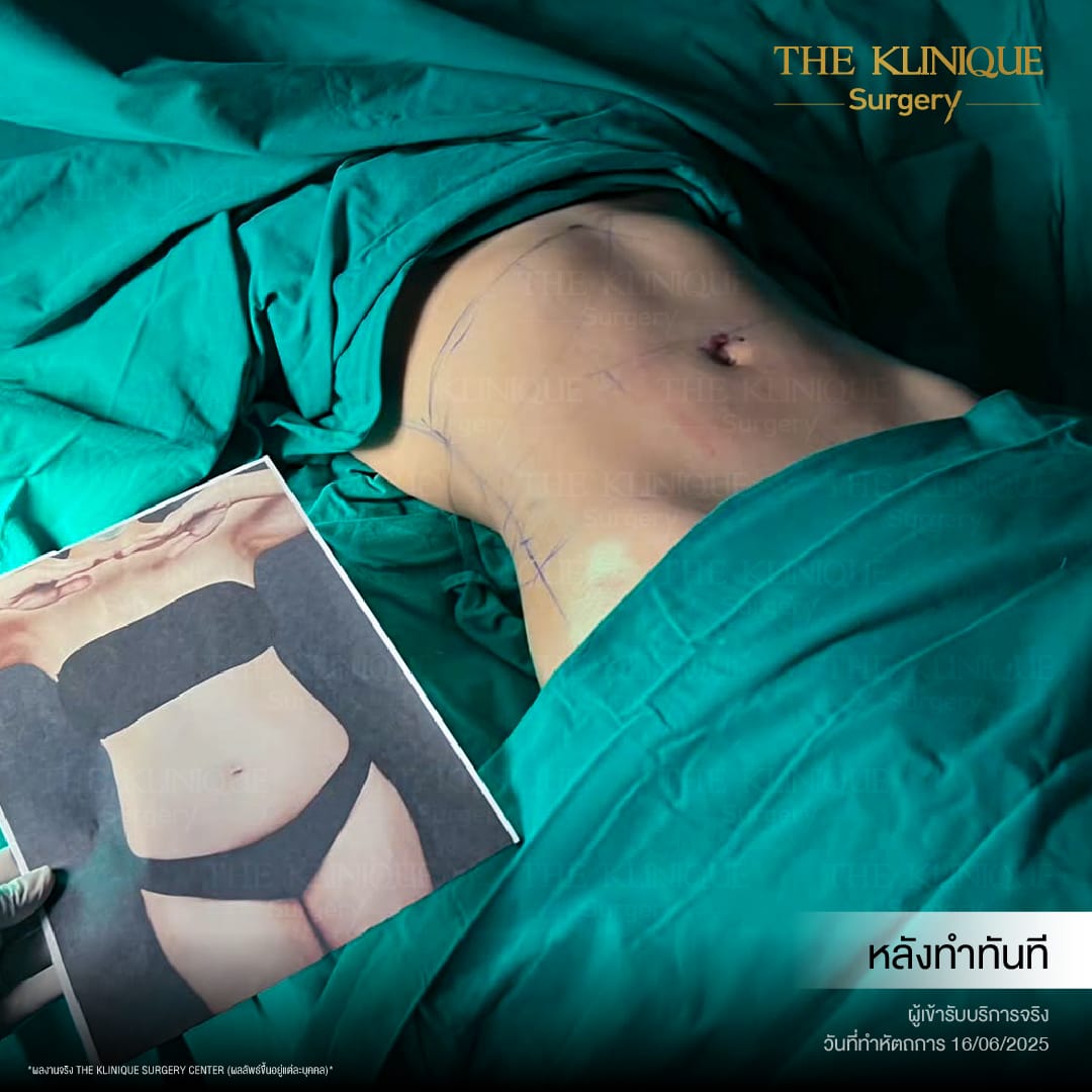 Liposuction_BodyContouring_11Lines