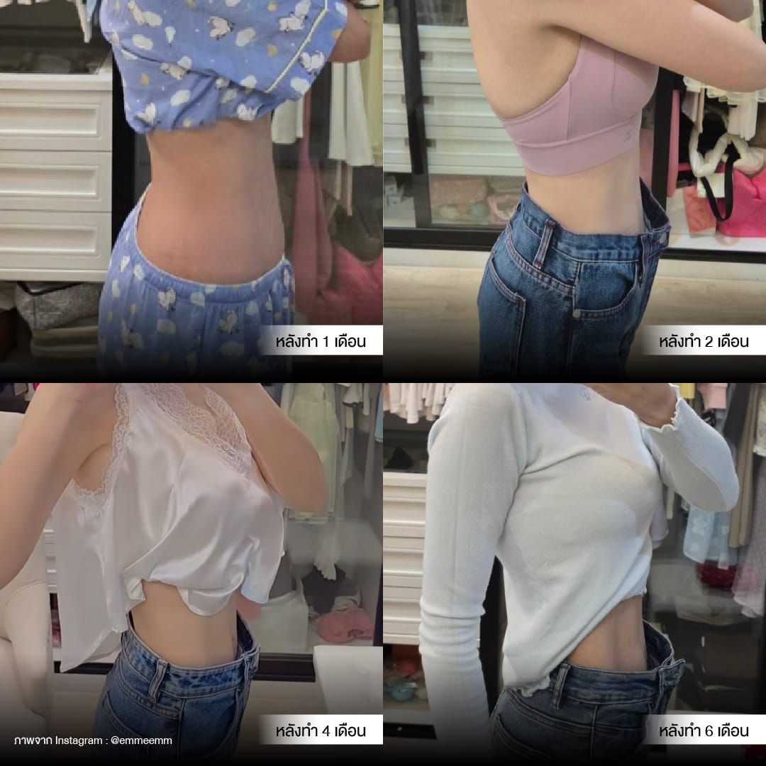 Liposuction_BodyContouring_11Lines