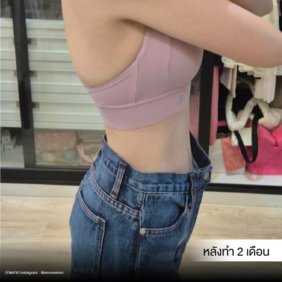 Liposuction_BodyContouring_11Lines