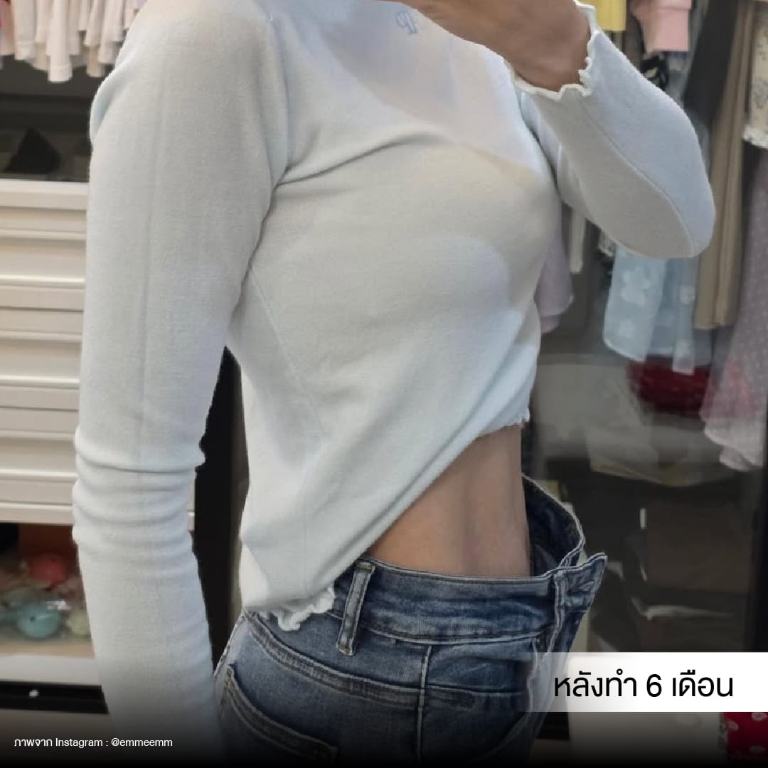 Liposuction_BodyContouring_11Lines