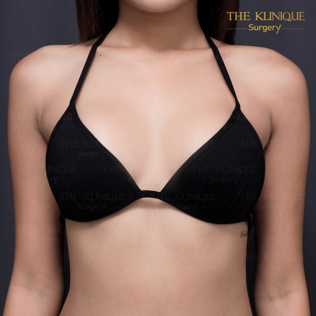 Nesty-review-Breast-Reconstruction