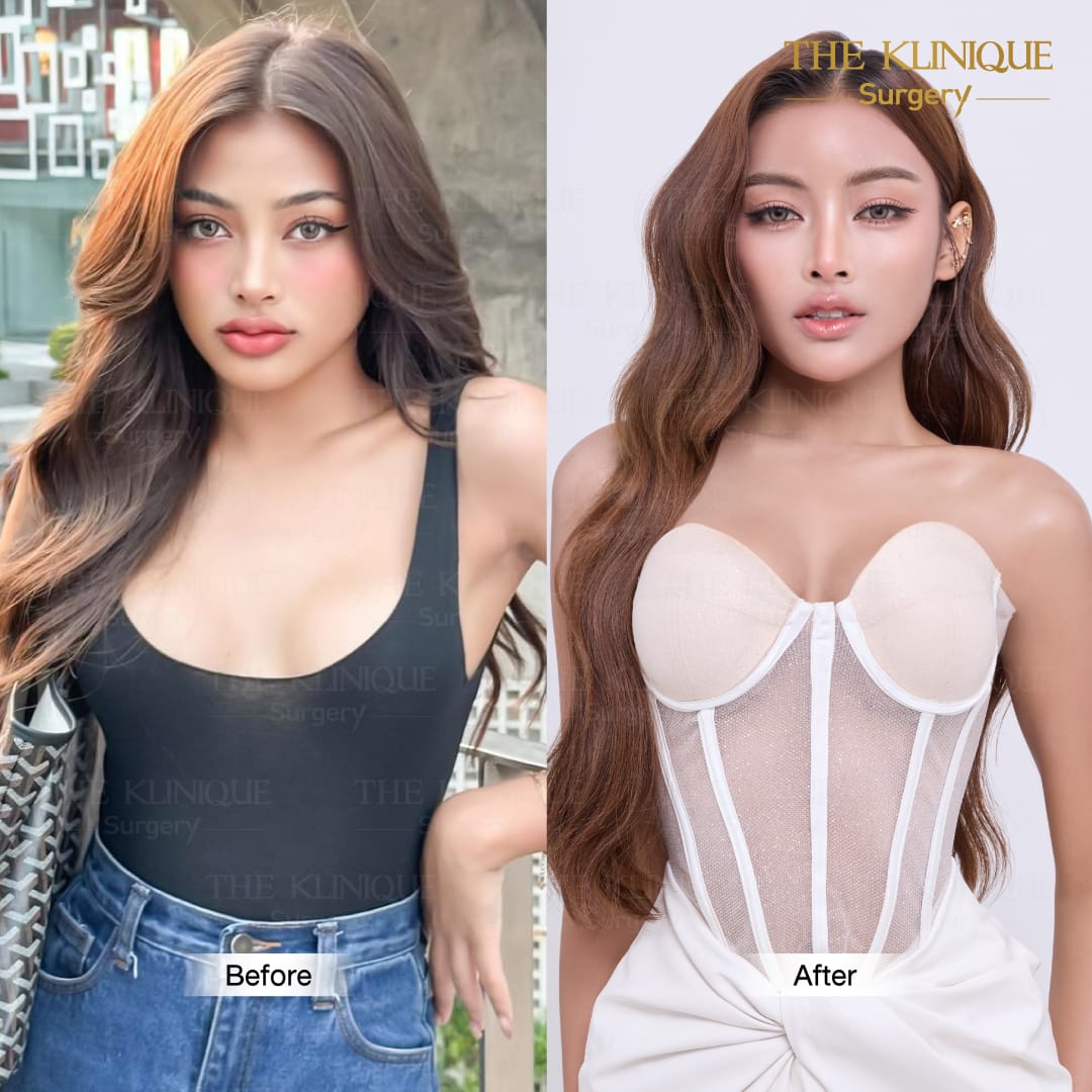 Nesty-review-Breast-Reconstruction