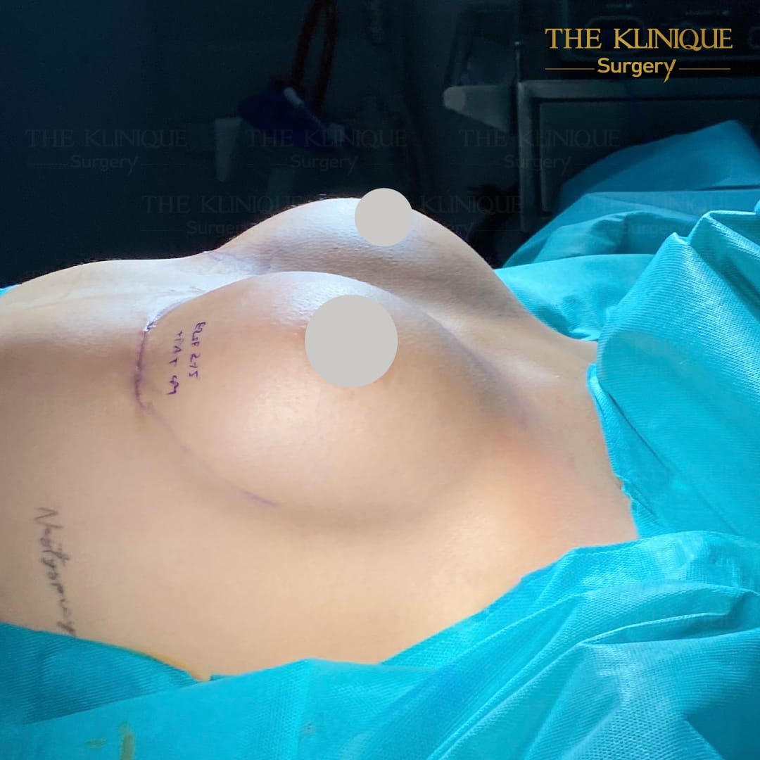 Nesty-review-Breast-Reconstruction