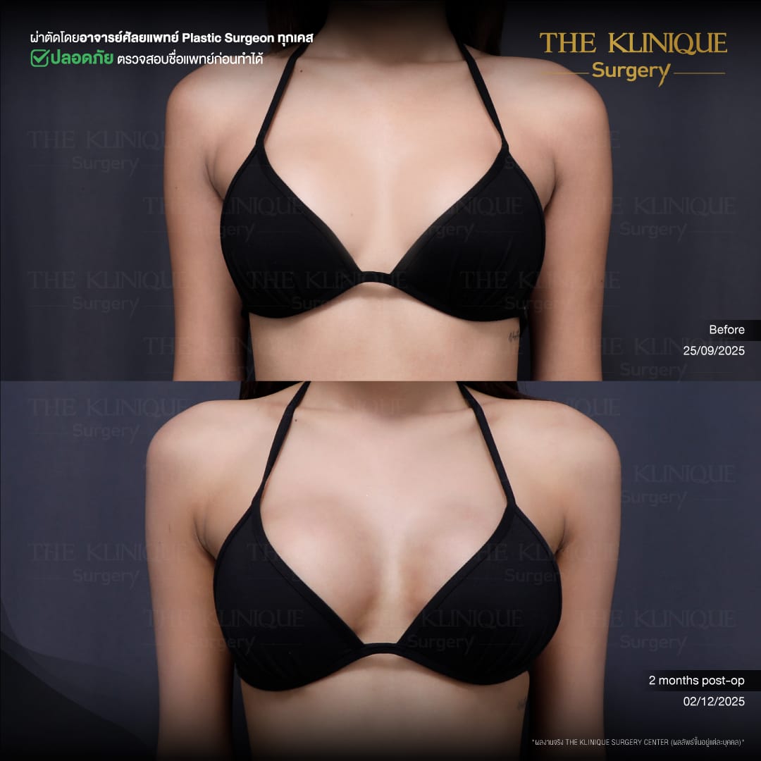 Nesty-review-Breast-Reconstruction