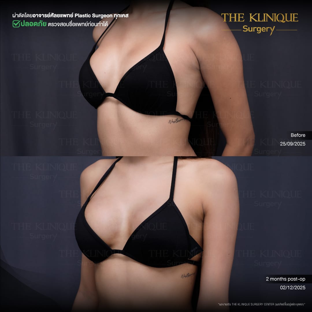 Nesty-review-Breast-Reconstruction