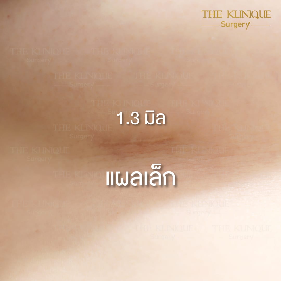 Nesty-review-Breast-Reconstruction