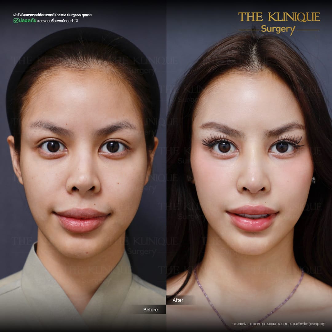 Review-Reconstructive-NoseSurgery-Nampetch