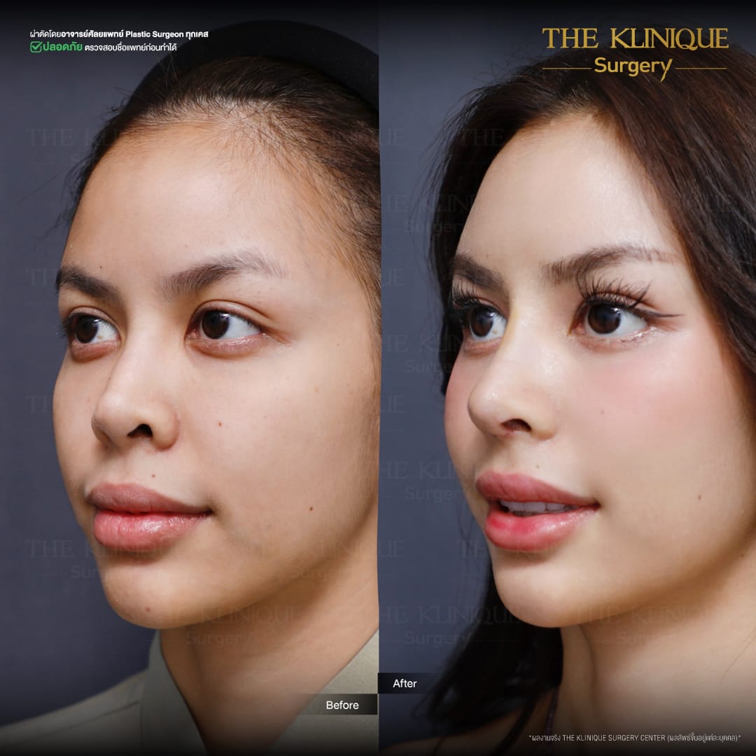 Review-Reconstructive-NoseSurgery-Nampetch