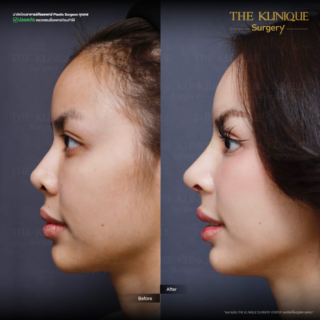 Review-Reconstructive-NoseSurgery-Nampetch
