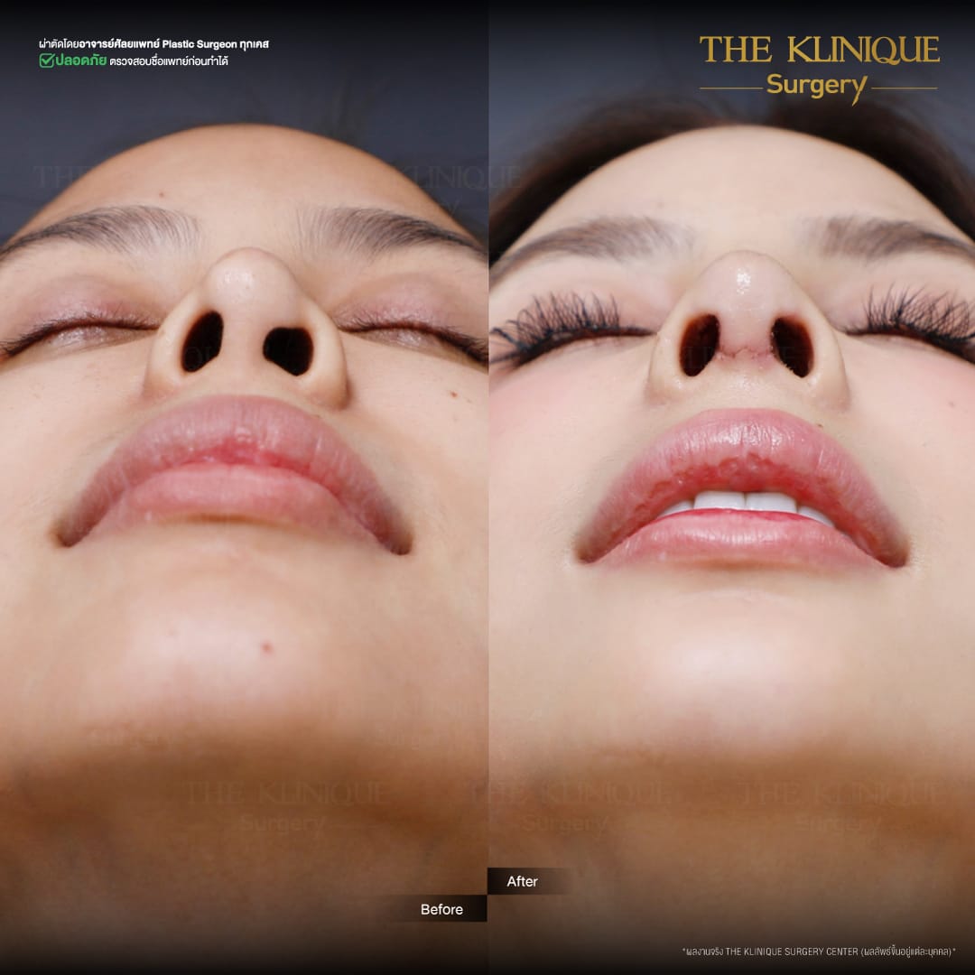 Review-Reconstructive-NoseSurgery-Nampetch