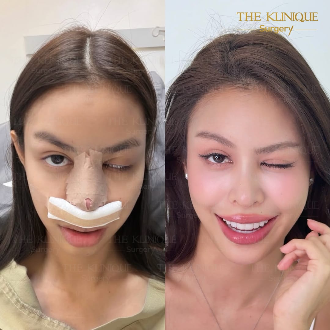 Review-Reconstructive-NoseSurgery-Nampetch