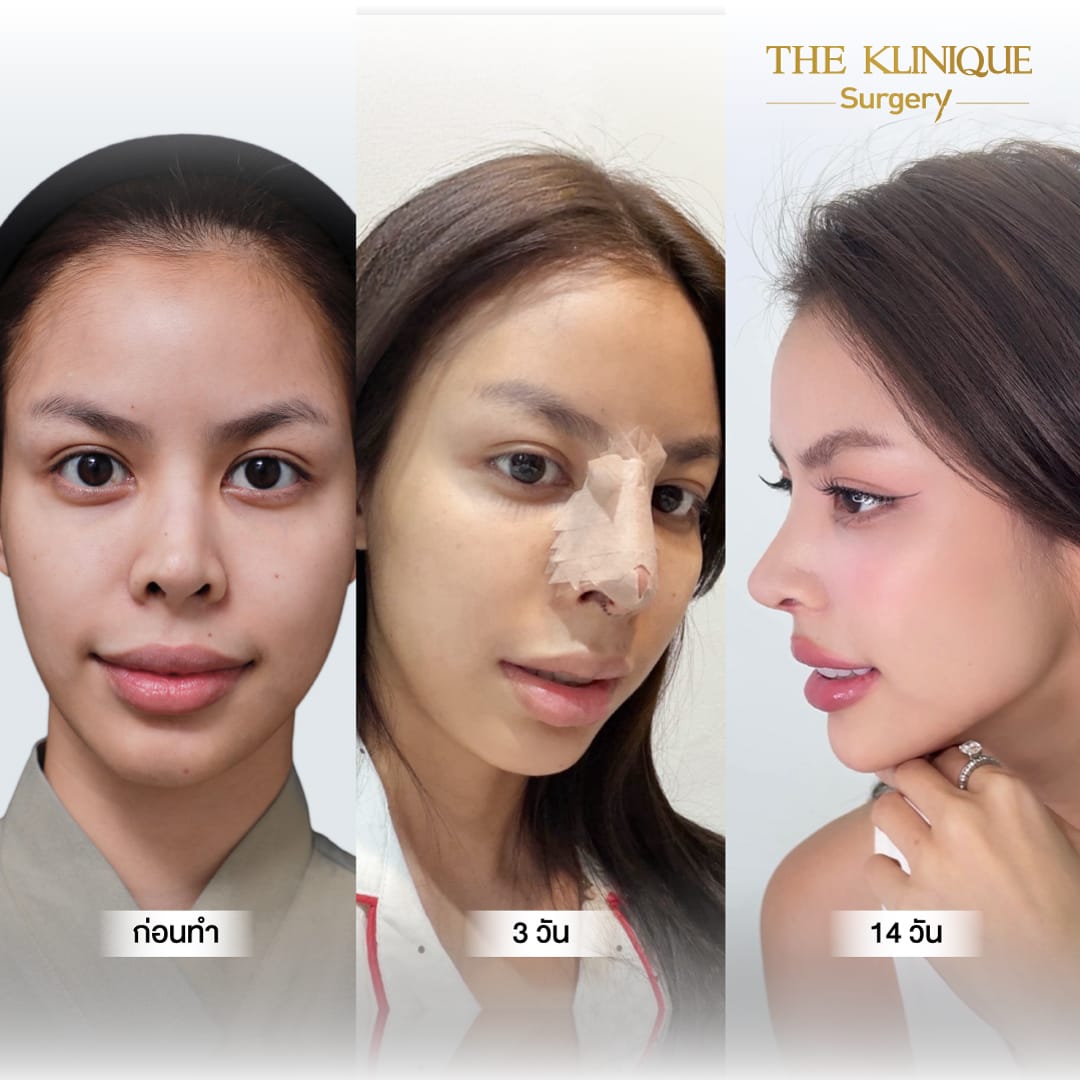 Review-Reconstructive-NoseSurgery-Nampetch