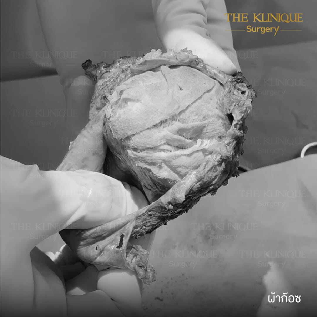 review-Breast-Reconstruction-Yokthong