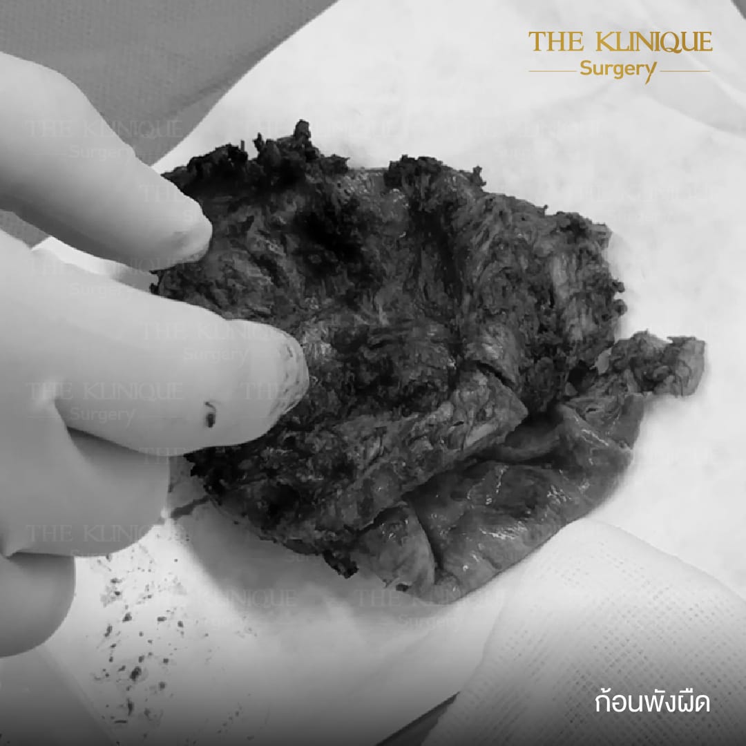 review-Breast-Reconstruction-Yokthong