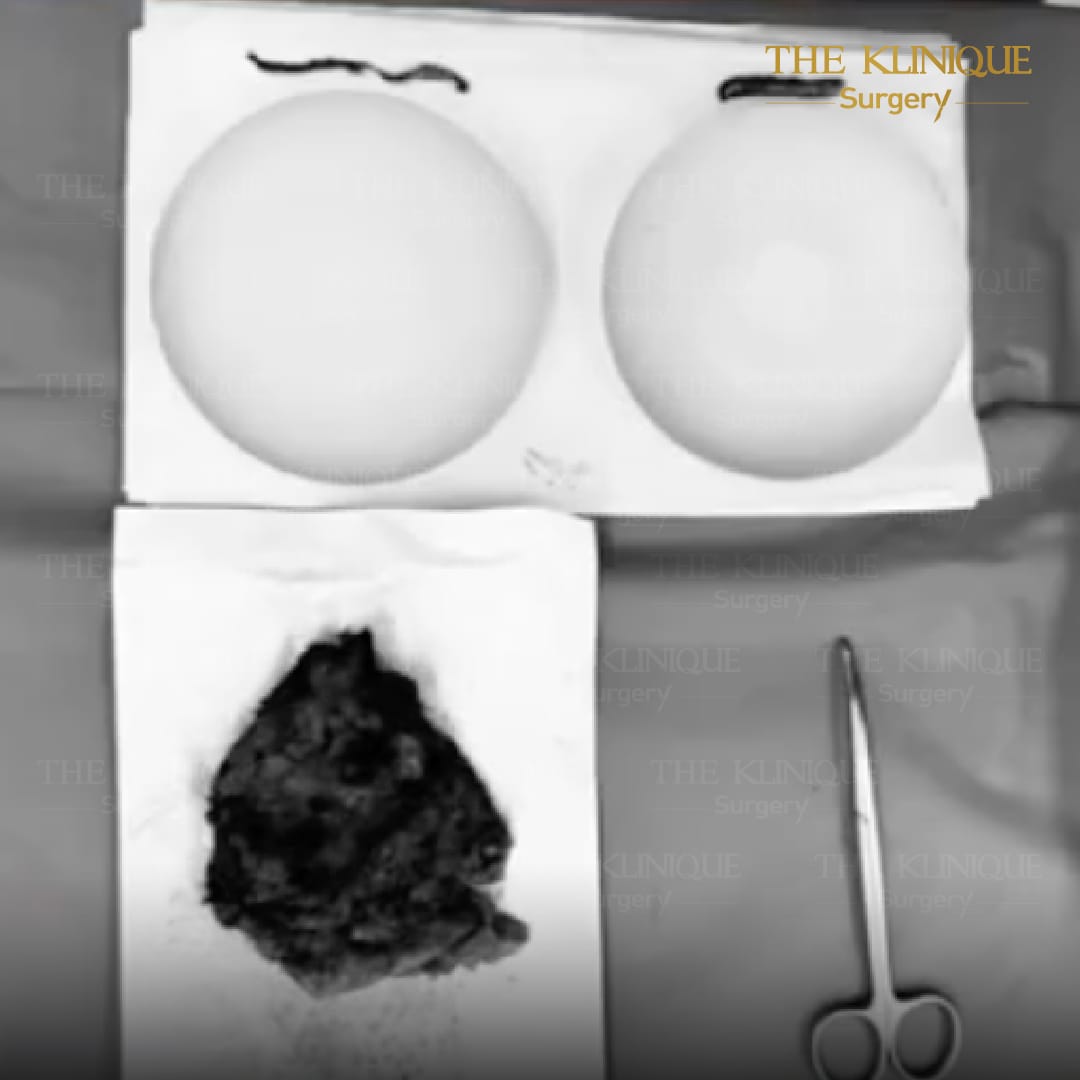 review-Breast-Reconstruction-Yokthong