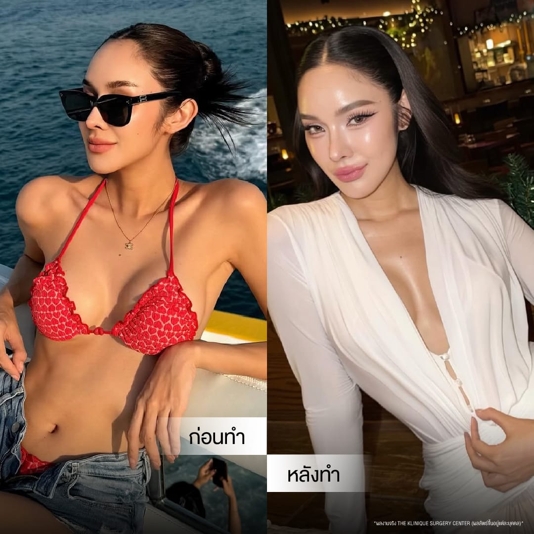 review-Breast-Reconstruction-Yokthong