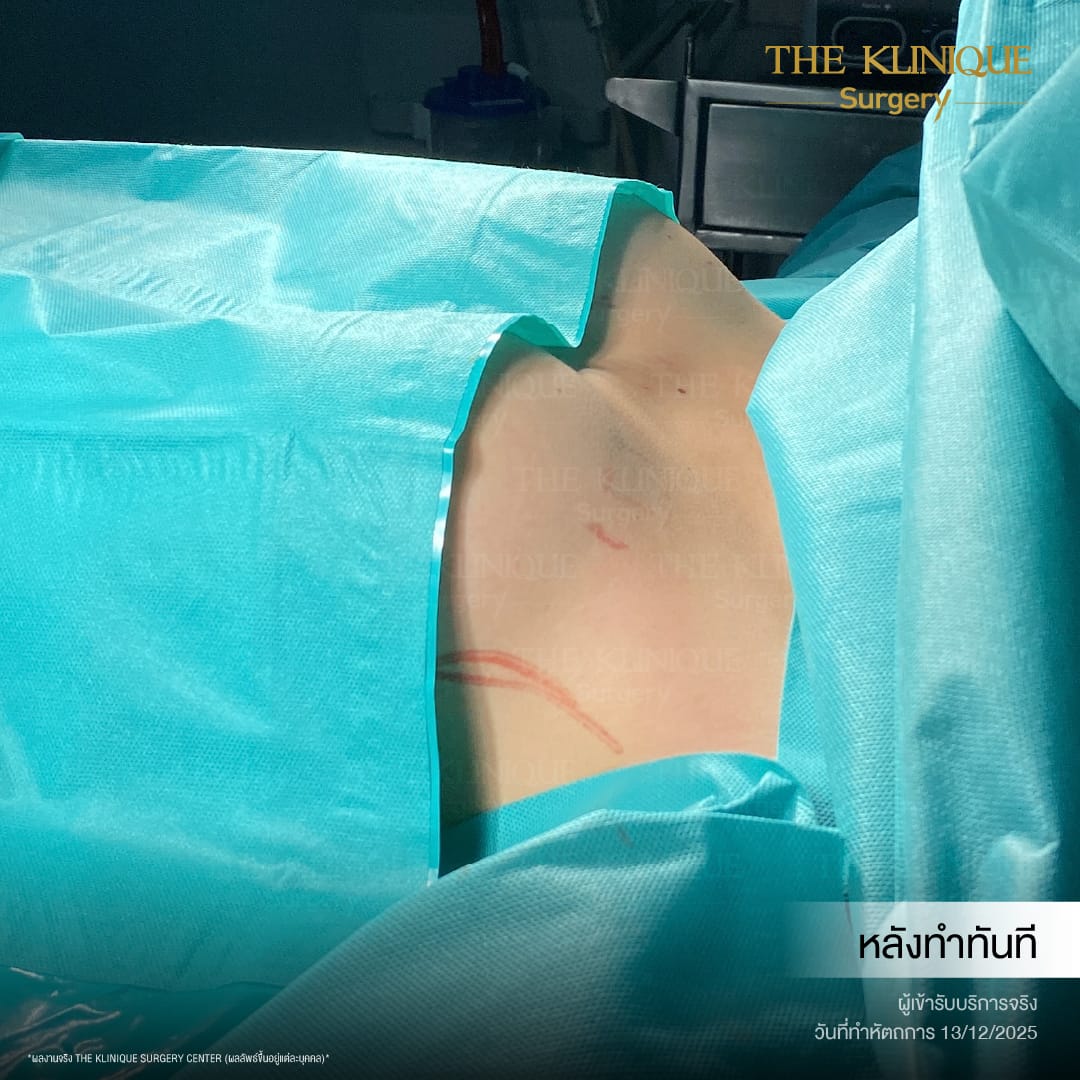 review-Breast-Reconstruction-Yokthong