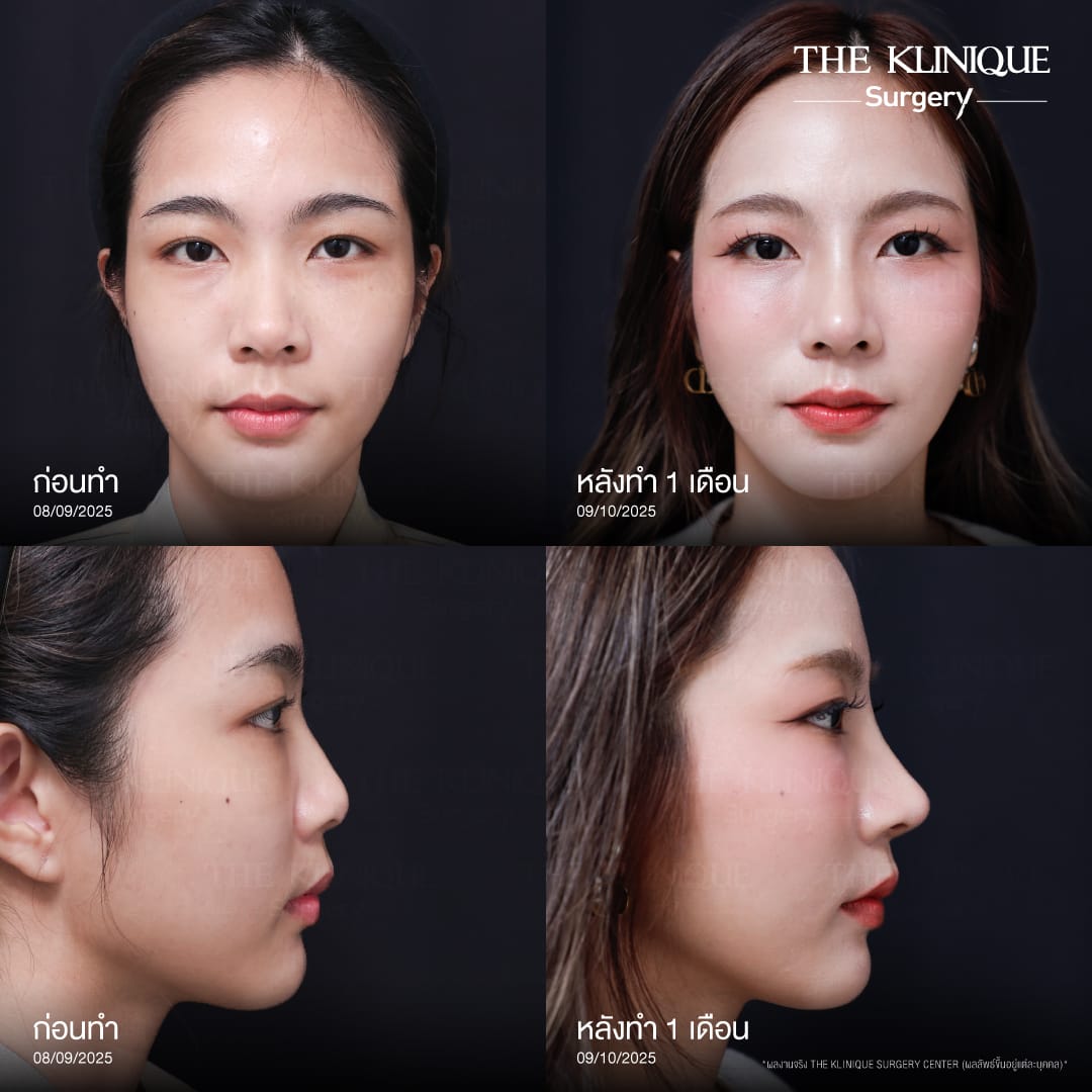 Review-SemiOpen-Rhinoplasty-KoreanStyle