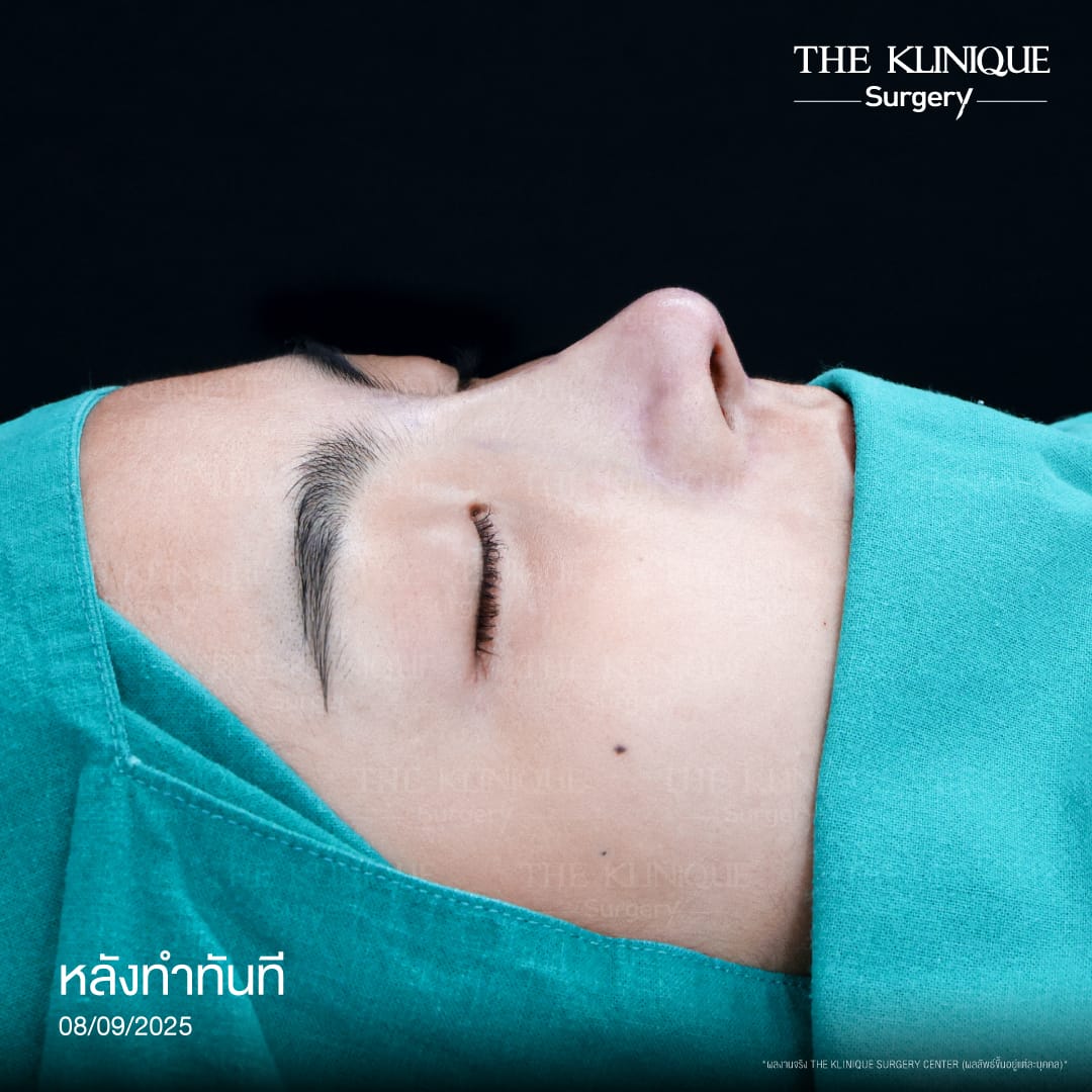 Review-SemiOpen-Rhinoplasty-KoreanStyle