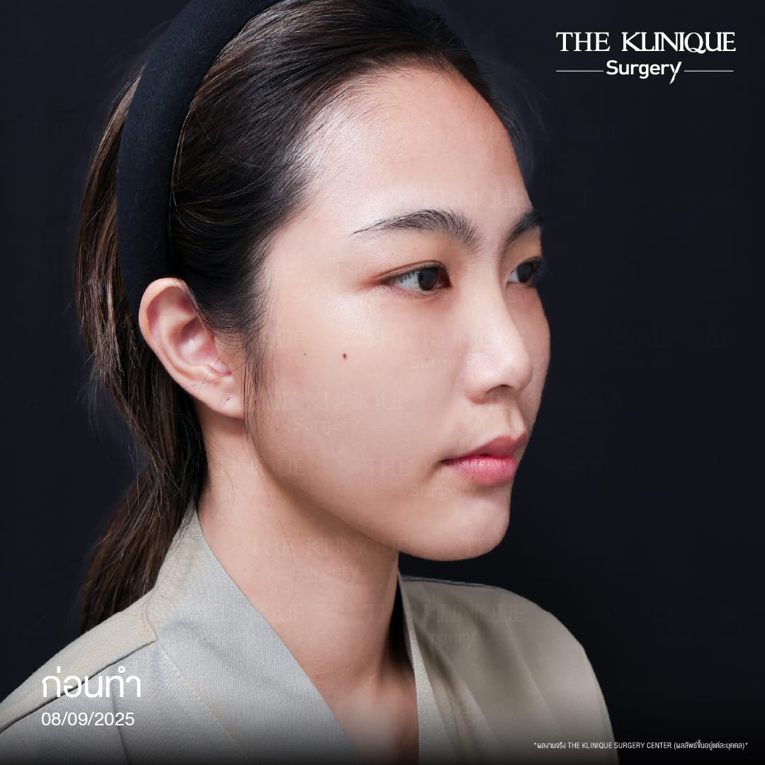 Review-SemiOpen-Rhinoplasty-KoreanStyle