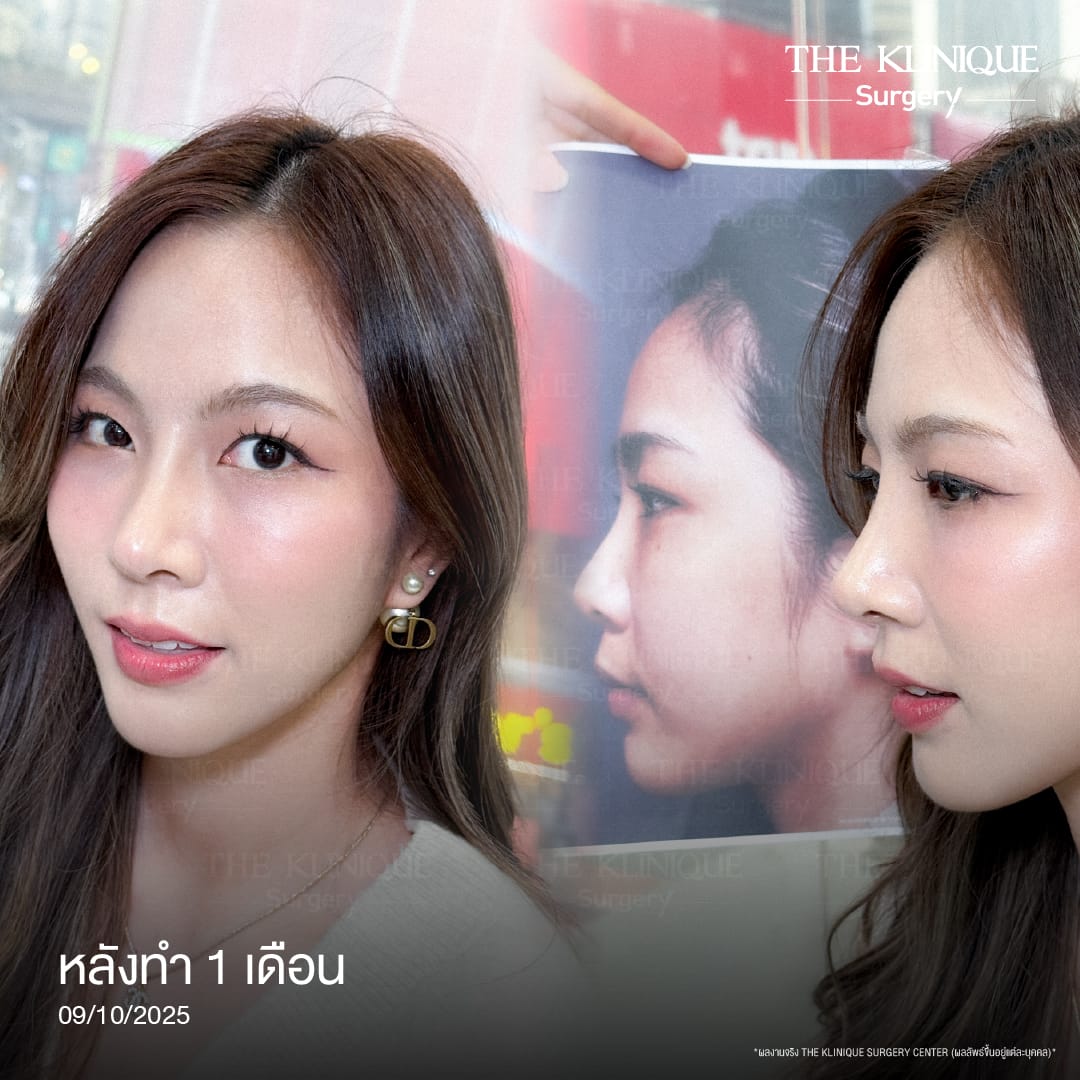 Review-SemiOpen-Rhinoplasty-KoreanStyle