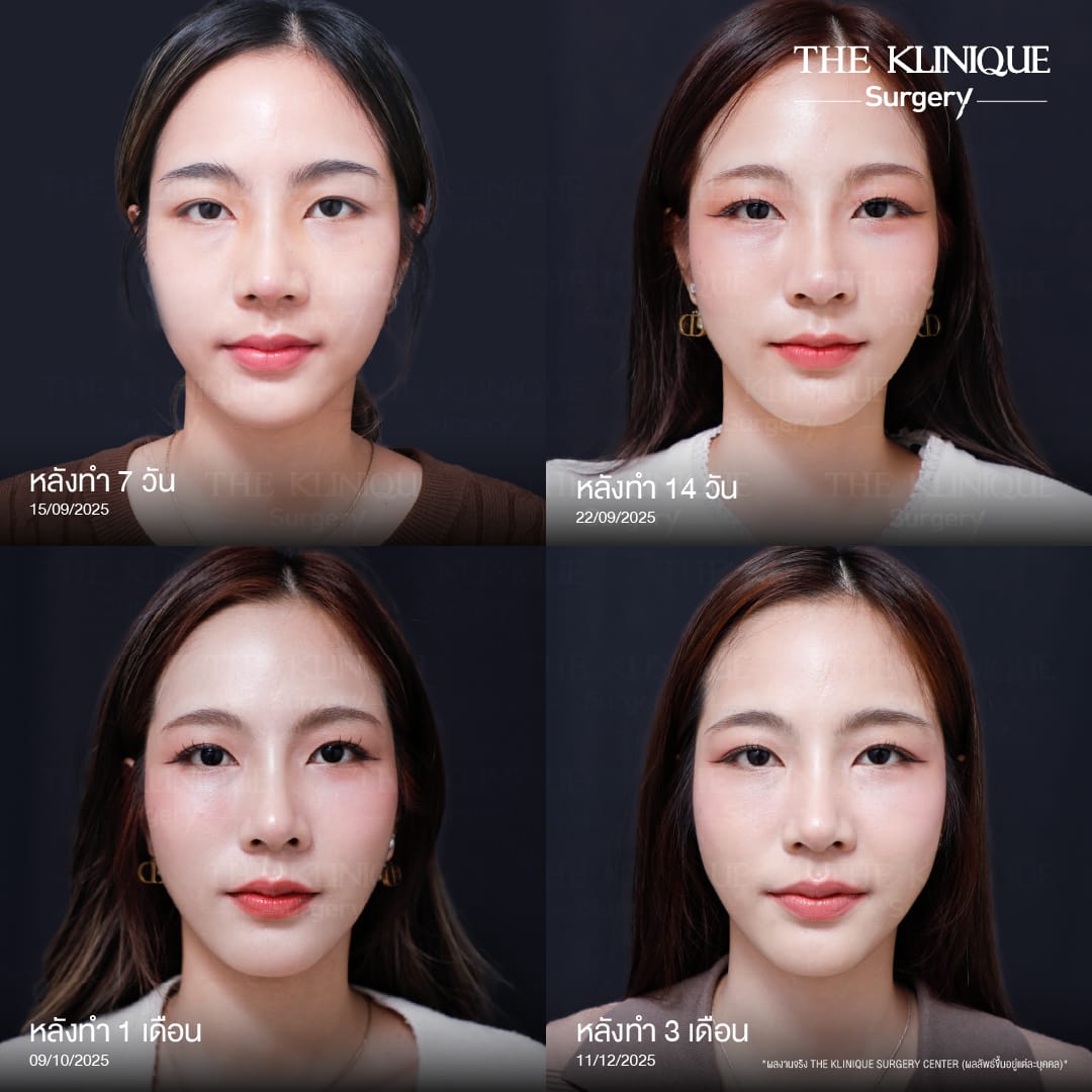 Review-SemiOpen-Rhinoplasty-KoreanStyle