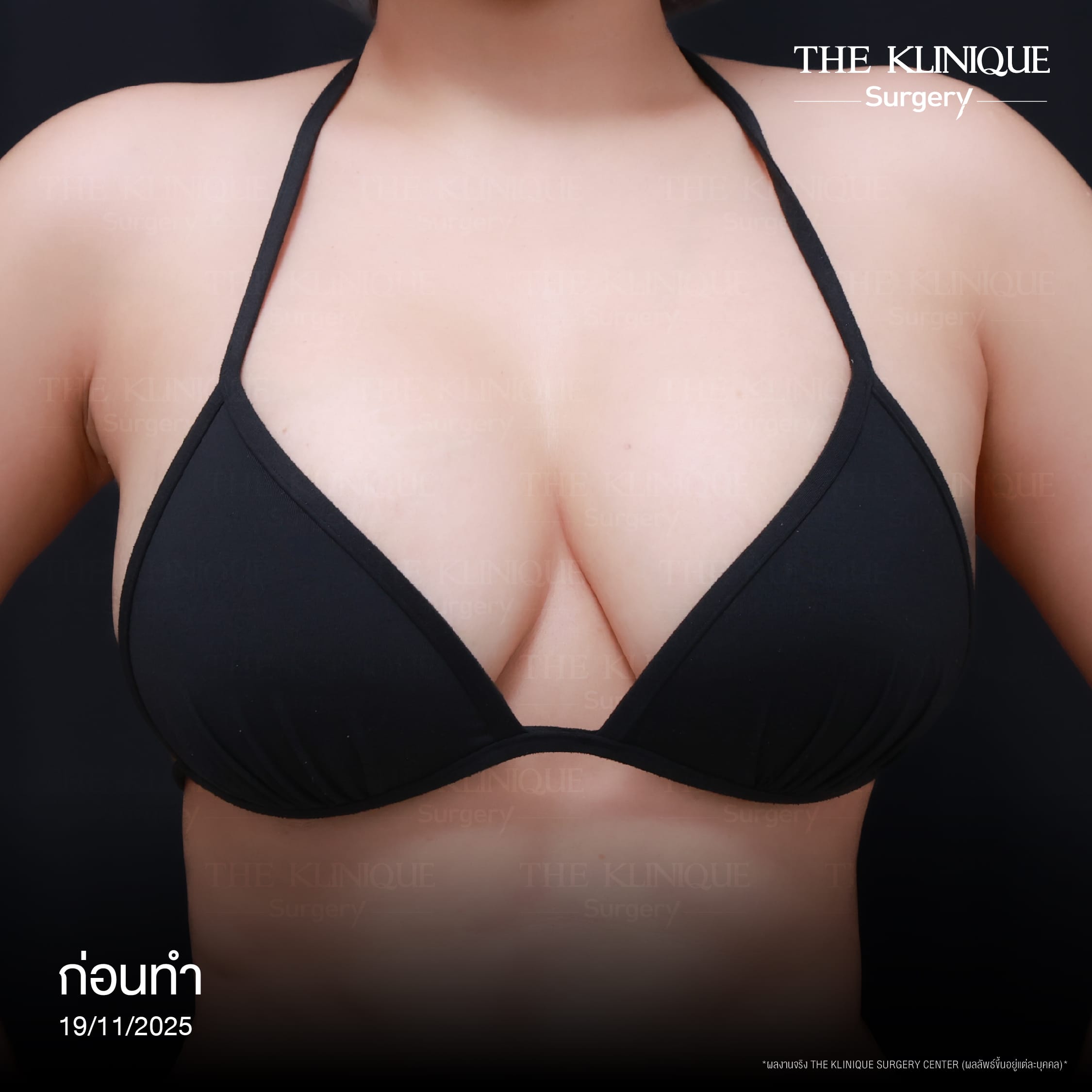 review-breast-lift-reconstruction