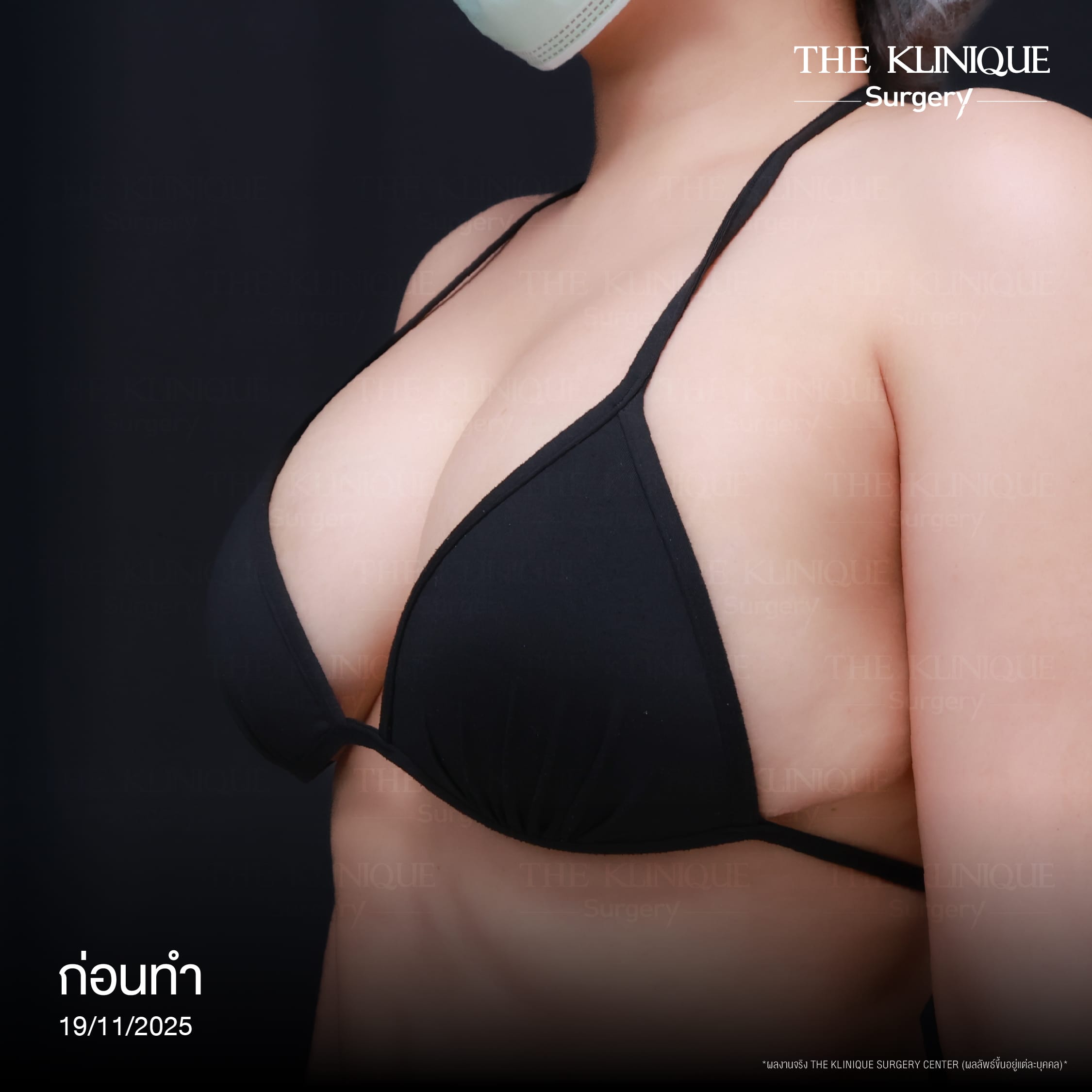 review-breast-lift-reconstruction