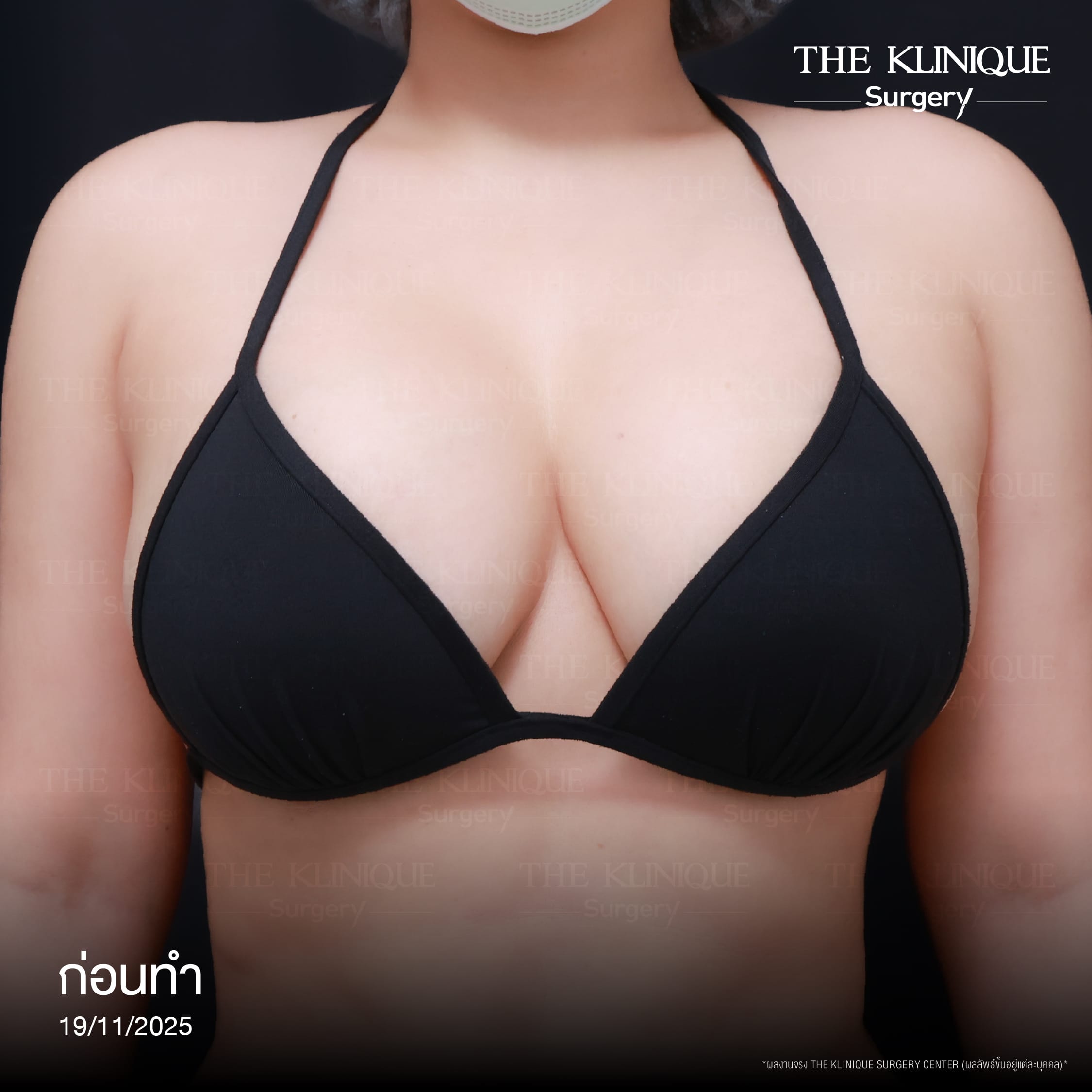 review-breast-lift-reconstruction