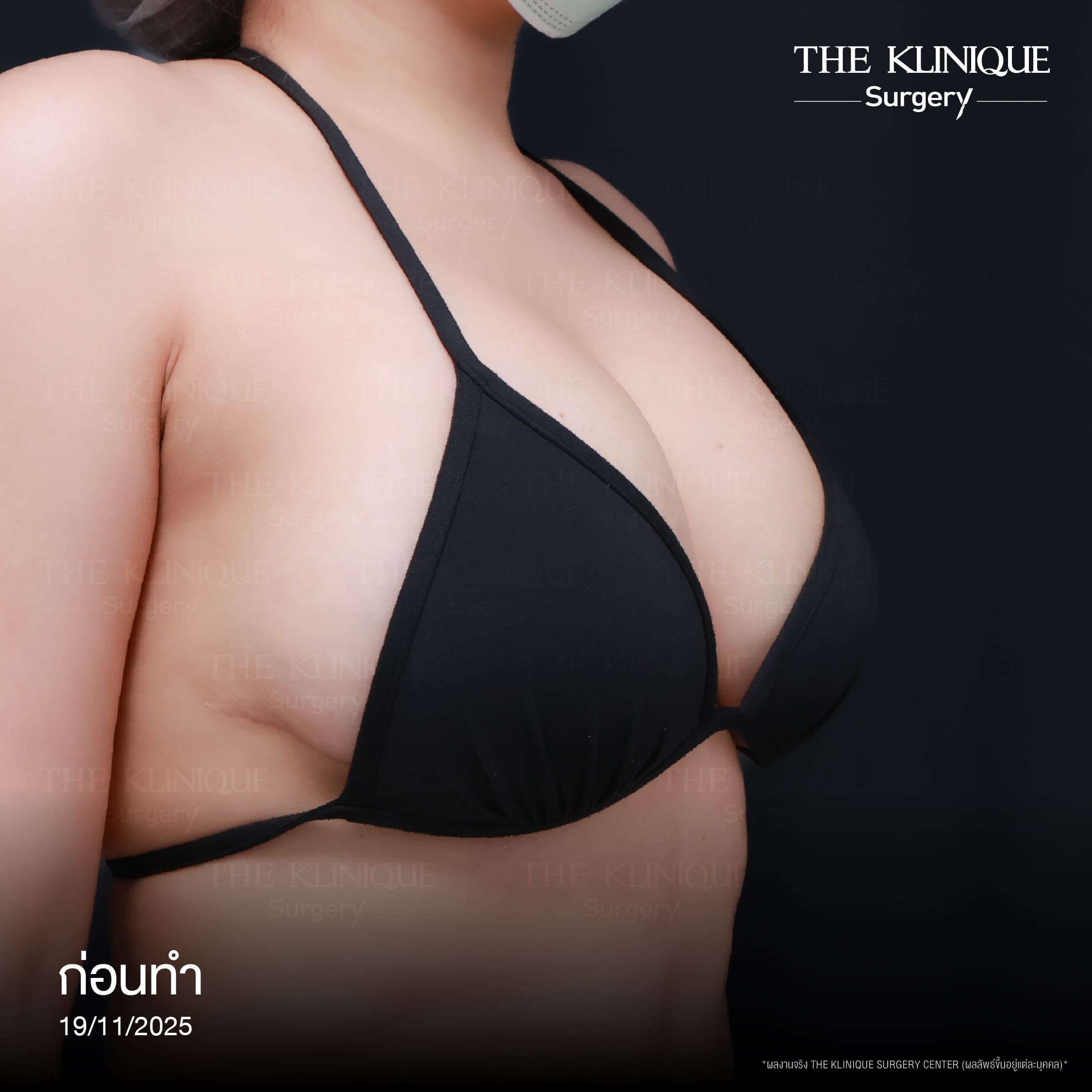 review-breast-lift-reconstruction