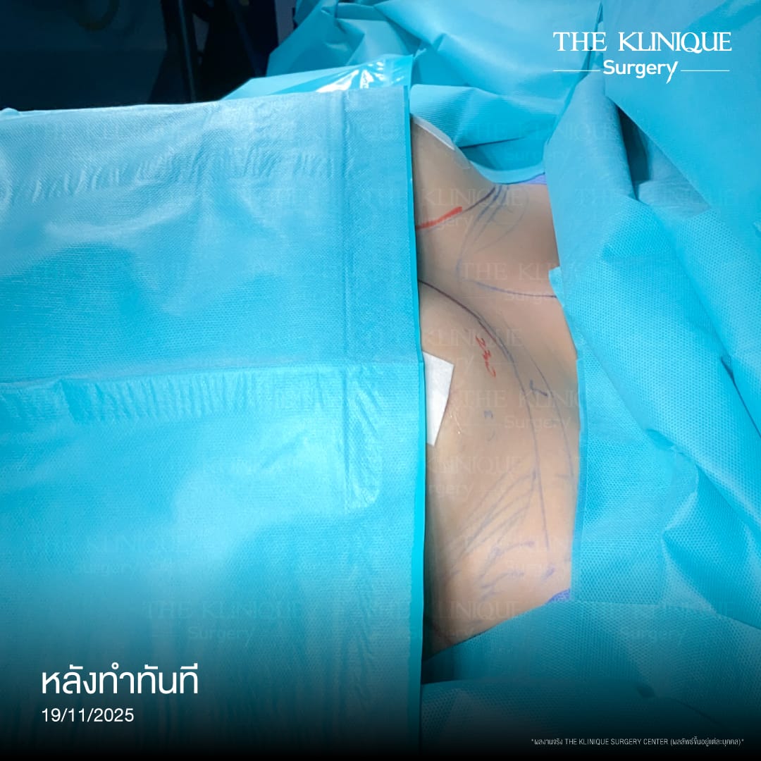 review-breast-lift-reconstruction