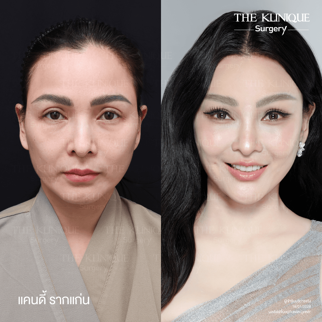 ดึงหน้าดารา, ดึงหน้า, ศัลยกรรมดึงหน้า,ดึงหน้าย้อนวัย, ดึงหน้าที่ไหนดี, ผ่าตัดดึงหน้า, ยกคิ้ว, ยกหางตา, หางตาตก, ดึงหน้าดารา, ดึงหน้ารีวิว, Facelift, Neck lift, Endotine, ยกคิ้ว Endotine,Foxy Eyes, แก้หนังตาตก , แก้ตาไม่เท่ากัน ,หนังตาตก,แก้หนังตาตก,ยกคิ้ว รีวิว, ยกคิ้วส่องกล้อง, ยกคิ้วที่ไหนดี, ยกคิ้ว,ศัลยกรรมยกคิ้ว,ดึงหน้าส่องกล้อง,ดึงหน้า Facelock, Hollywood facelock,ดึงหน้าFacelift, รีวิวFacelift, ดึงหน้าย้อนวัย, ดึงหน้าลดอายุ