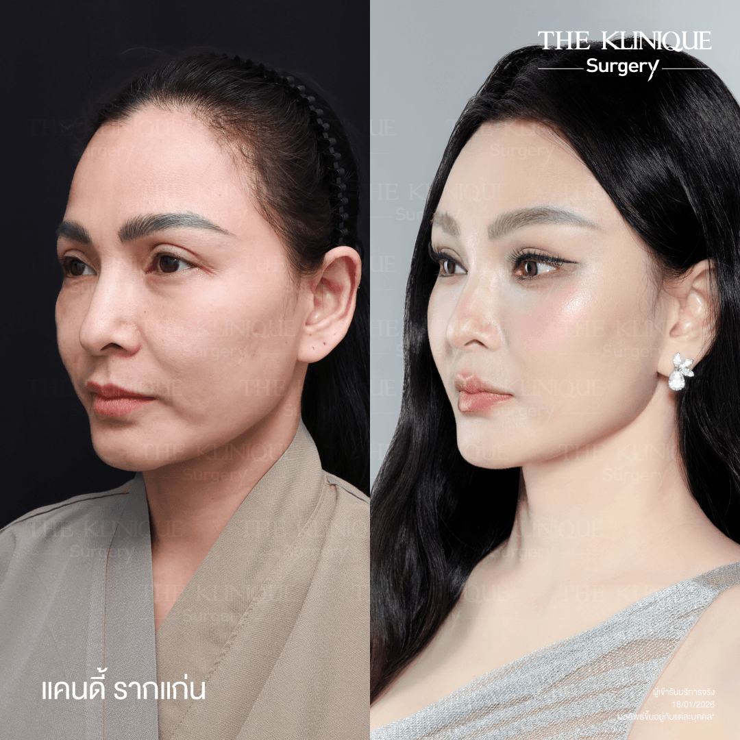 ดึงหน้าดารา, ดึงหน้า, ศัลยกรรมดึงหน้า,ดึงหน้าย้อนวัย, ดึงหน้าที่ไหนดี, ผ่าตัดดึงหน้า, ยกคิ้ว, ยกหางตา, หางตาตก, ดึงหน้าดารา, ดึงหน้ารีวิว, Facelift, Neck lift, Endotine, ยกคิ้ว Endotine,Foxy Eyes, แก้หนังตาตก , แก้ตาไม่เท่ากัน ,หนังตาตก,แก้หนังตาตก,ยกคิ้ว รีวิว, ยกคิ้วส่องกล้อง, ยกคิ้วที่ไหนดี, ยกคิ้ว,ศัลยกรรมยกคิ้ว,ดึงหน้าส่องกล้อง,ดึงหน้า Facelock, Hollywood facelock,ดึงหน้าFacelift, รีวิวFacelift, ดึงหน้าย้อนวัย, ดึงหน้าลดอายุ