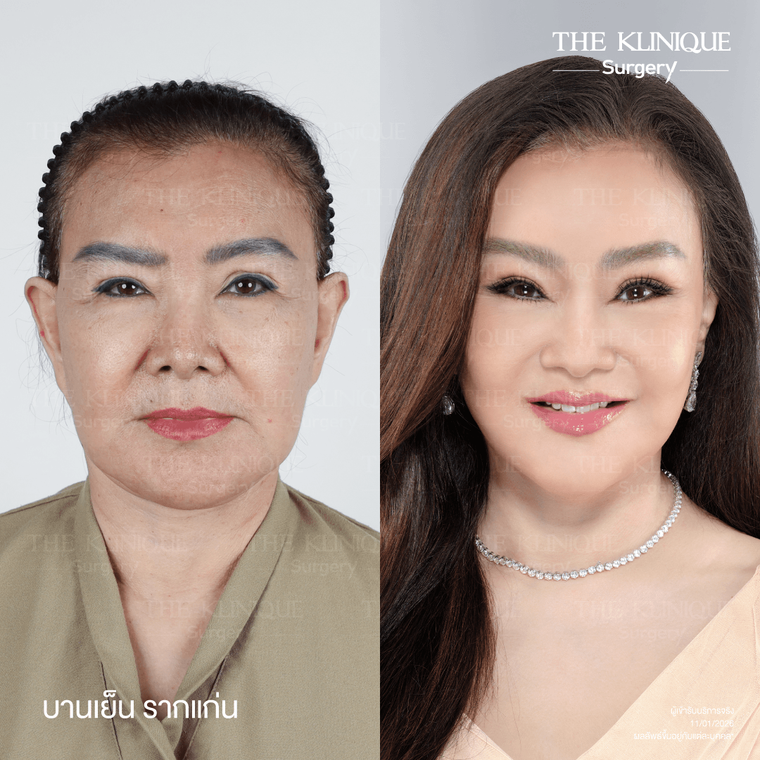 ดึงหน้าดารา, ดึงหน้า, ศัลยกรรมดึงหน้า,ดึงหน้าย้อนวัย, ดึงหน้าที่ไหนดี, ผ่าตัดดึงหน้า, ยกคิ้ว, ยกหางตา, หางตาตก, ดึงหน้าดารา, ดึงหน้ารีวิว, Facelift, Neck lift, Endotine, ยกคิ้ว Endotine,Foxy Eyes, แก้หนังตาตก , แก้ตาไม่เท่ากัน ,หนังตาตก,แก้หนังตาตก,ยกคิ้ว รีวิว, ยกคิ้วส่องกล้อง, ยกคิ้วที่ไหนดี, ยกคิ้ว,ศัลยกรรมยกคิ้ว,ดึงหน้าส่องกล้อง,ดึงหน้า Facelock, Hollywood facelock,ดึงหน้าFacelift, รีวิวFacelift, ดึงหน้าย้อนวัย, ดึงหน้าลดอายุ