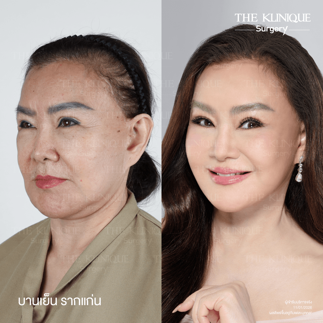 ดึงหน้าดารา, ดึงหน้า, ศัลยกรรมดึงหน้า,ดึงหน้าย้อนวัย, ดึงหน้าที่ไหนดี, ผ่าตัดดึงหน้า, ยกคิ้ว, ยกหางตา, หางตาตก, ดึงหน้าดารา, ดึงหน้ารีวิว, Facelift, Neck lift, Endotine, ยกคิ้ว Endotine,Foxy Eyes, แก้หนังตาตก , แก้ตาไม่เท่ากัน ,หนังตาตก,แก้หนังตาตก,ยกคิ้ว รีวิว, ยกคิ้วส่องกล้อง, ยกคิ้วที่ไหนดี, ยกคิ้ว,ศัลยกรรมยกคิ้ว,ดึงหน้าส่องกล้อง,ดึงหน้า Facelock, Hollywood facelock,ดึงหน้าFacelift, รีวิวFacelift, ดึงหน้าย้อนวัย, ดึงหน้าลดอายุ