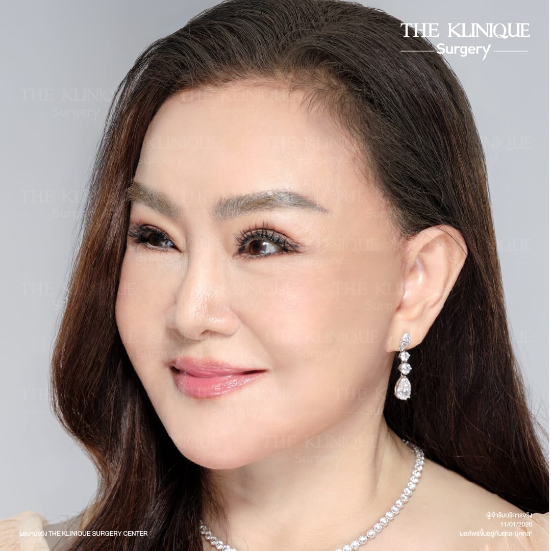 ดึงหน้าดารา, ดึงหน้า, ศัลยกรรมดึงหน้า,ดึงหน้าย้อนวัย, ดึงหน้าที่ไหนดี, ผ่าตัดดึงหน้า, ยกคิ้ว, ยกหางตา, หางตาตก, ดึงหน้าดารา, ดึงหน้ารีวิว, Facelift, Neck lift, Endotine, ยกคิ้ว Endotine,Foxy Eyes, แก้หนังตาตก , แก้ตาไม่เท่ากัน ,หนังตาตก,แก้หนังตาตก,ยกคิ้ว รีวิว, ยกคิ้วส่องกล้อง, ยกคิ้วที่ไหนดี, ยกคิ้ว,ศัลยกรรมยกคิ้ว,ดึงหน้าส่องกล้อง,ดึงหน้า Facelock, Hollywood facelock,ดึงหน้าFacelift, รีวิวFacelift, ดึงหน้าย้อนวัย, ดึงหน้าลดอายุ