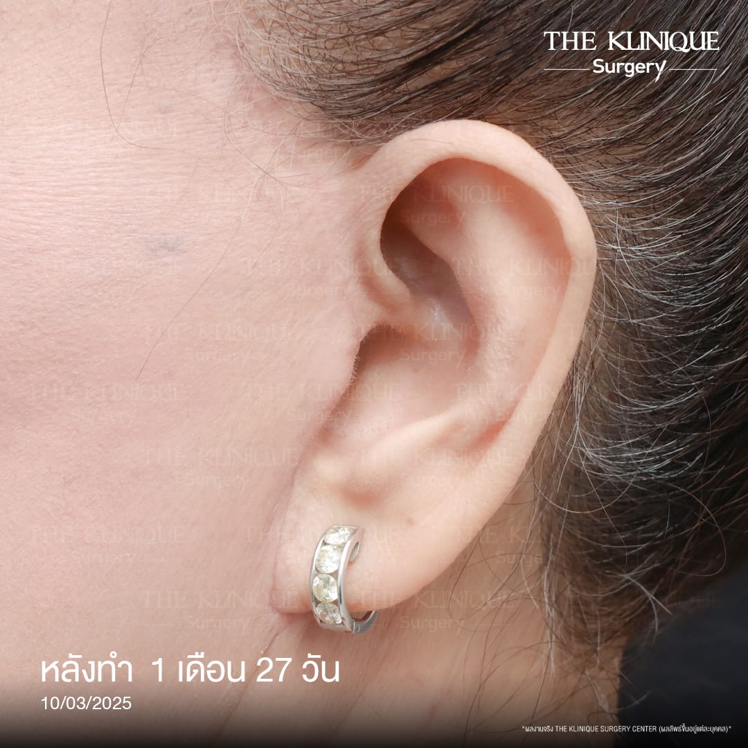 ดึงหน้าดารา, ดึงหน้า, ศัลยกรรมดึงหน้า,ดึงหน้าย้อนวัย, ดึงหน้าที่ไหนดี, ผ่าตัดดึงหน้า, ยกคิ้ว, ยกหางตา, หางตาตก, ดึงหน้าดารา, ดึงหน้ารีวิว, Facelift, Neck lift, Endotine, ยกคิ้ว Endotine,Foxy Eyes, แก้หนังตาตก , แก้ตาไม่เท่ากัน ,หนังตาตก,แก้หนังตาตก,ยกคิ้ว รีวิว, ยกคิ้วส่องกล้อง, ยกคิ้วที่ไหนดี, ยกคิ้ว,ศัลยกรรมยกคิ้ว,ดึงหน้าส่องกล้อง,ดึงหน้า Facelock, Hollywood facelock,ดึงหน้าFacelift, รีวิวFacelift, ดึงหน้าย้อนวัย, ดึงหน้าลดอายุ