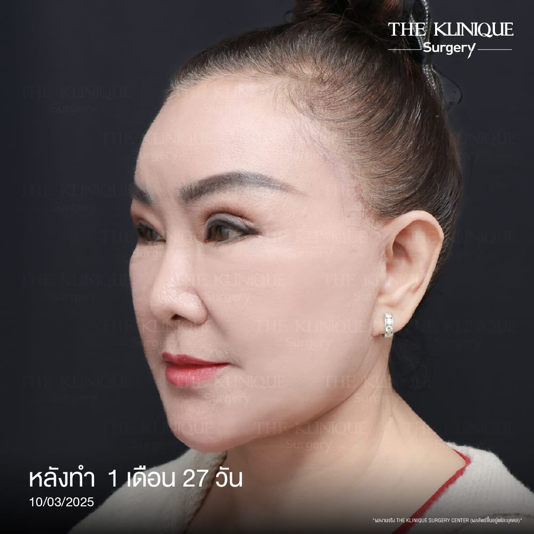 ดึงหน้าดารา, ดึงหน้า, ศัลยกรรมดึงหน้า,ดึงหน้าย้อนวัย, ดึงหน้าที่ไหนดี, ผ่าตัดดึงหน้า, ยกคิ้ว, ยกหางตา, หางตาตก, ดึงหน้าดารา, ดึงหน้ารีวิว, Facelift, Neck lift, Endotine, ยกคิ้ว Endotine,Foxy Eyes, แก้หนังตาตก , แก้ตาไม่เท่ากัน ,หนังตาตก,แก้หนังตาตก,ยกคิ้ว รีวิว, ยกคิ้วส่องกล้อง, ยกคิ้วที่ไหนดี, ยกคิ้ว,ศัลยกรรมยกคิ้ว,ดึงหน้าส่องกล้อง,ดึงหน้า Facelock, Hollywood facelock,ดึงหน้าFacelift, รีวิวFacelift, ดึงหน้าย้อนวัย, ดึงหน้าลดอายุ