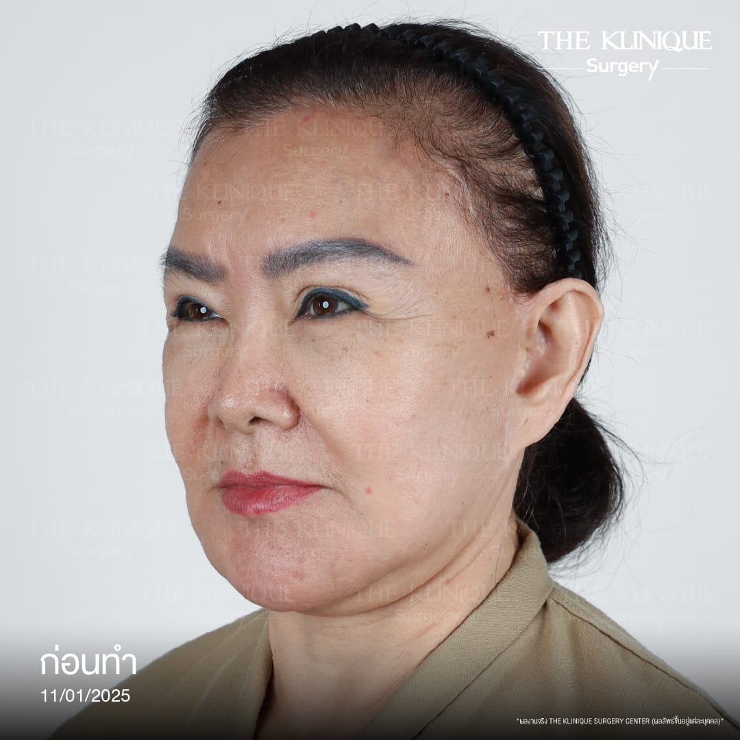 ดึงหน้าดารา, ดึงหน้า, ศัลยกรรมดึงหน้า,ดึงหน้าย้อนวัย, ดึงหน้าที่ไหนดี, ผ่าตัดดึงหน้า, ยกคิ้ว, ยกหางตา, หางตาตก, ดึงหน้าดารา, ดึงหน้ารีวิว, Facelift, Neck lift, Endotine, ยกคิ้ว Endotine,Foxy Eyes, แก้หนังตาตก , แก้ตาไม่เท่ากัน ,หนังตาตก,แก้หนังตาตก,ยกคิ้ว รีวิว, ยกคิ้วส่องกล้อง, ยกคิ้วที่ไหนดี, ยกคิ้ว,ศัลยกรรมยกคิ้ว,ดึงหน้าส่องกล้อง,ดึงหน้า Facelock, Hollywood facelock,ดึงหน้าFacelift, รีวิวFacelift, ดึงหน้าย้อนวัย, ดึงหน้าลดอายุ