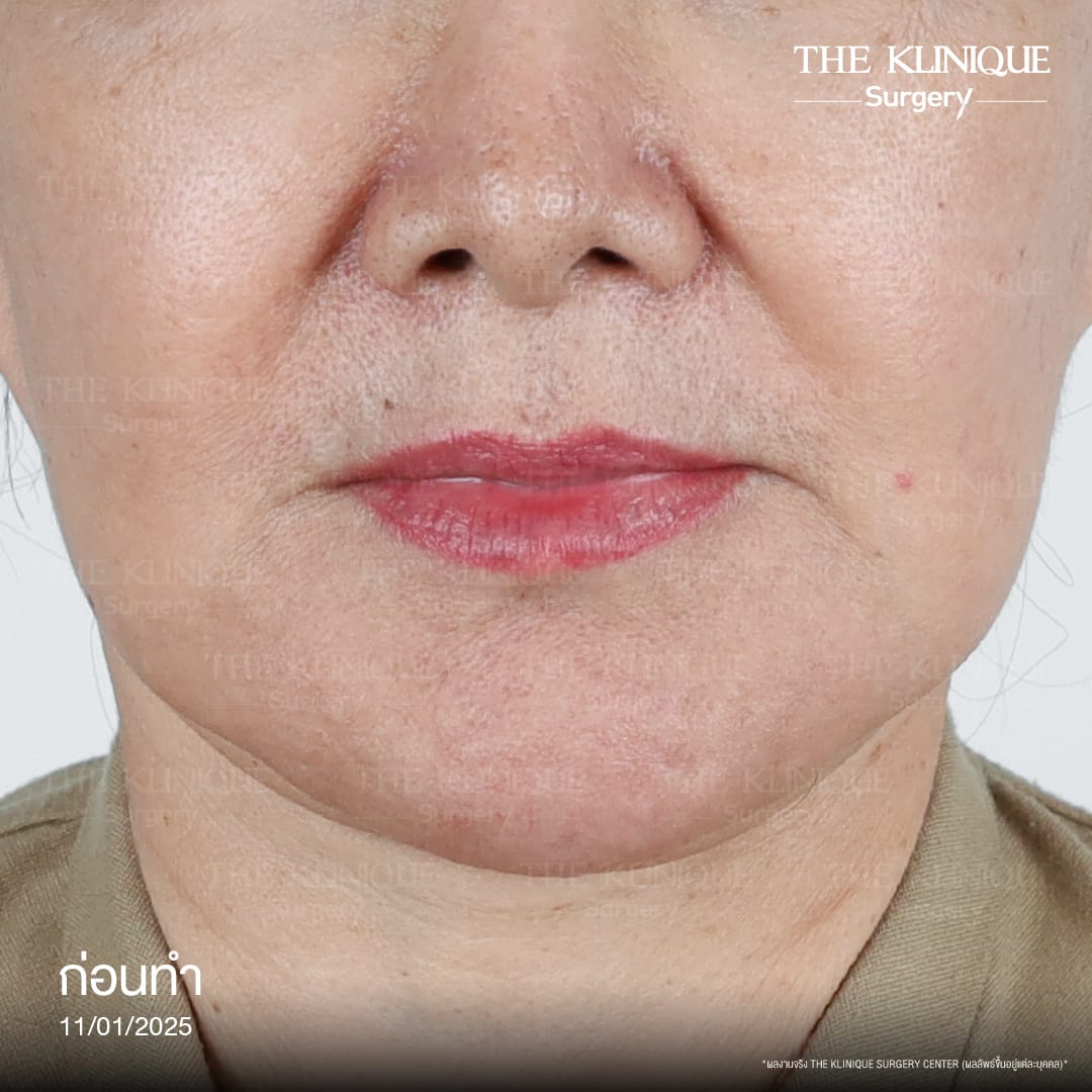 ดึงหน้าดารา, ดึงหน้า, ศัลยกรรมดึงหน้า,ดึงหน้าย้อนวัย, ดึงหน้าที่ไหนดี, ผ่าตัดดึงหน้า, ยกคิ้ว, ยกหางตา, หางตาตก, ดึงหน้าดารา, ดึงหน้ารีวิว, Facelift, Neck lift, Endotine, ยกคิ้ว Endotine,Foxy Eyes, แก้หนังตาตก , แก้ตาไม่เท่ากัน ,หนังตาตก,แก้หนังตาตก,ยกคิ้ว รีวิว, ยกคิ้วส่องกล้อง, ยกคิ้วที่ไหนดี, ยกคิ้ว,ศัลยกรรมยกคิ้ว,ดึงหน้าส่องกล้อง,ดึงหน้า Facelock, Hollywood facelock,ดึงหน้าFacelift, รีวิวFacelift, ดึงหน้าย้อนวัย, ดึงหน้าลดอายุ