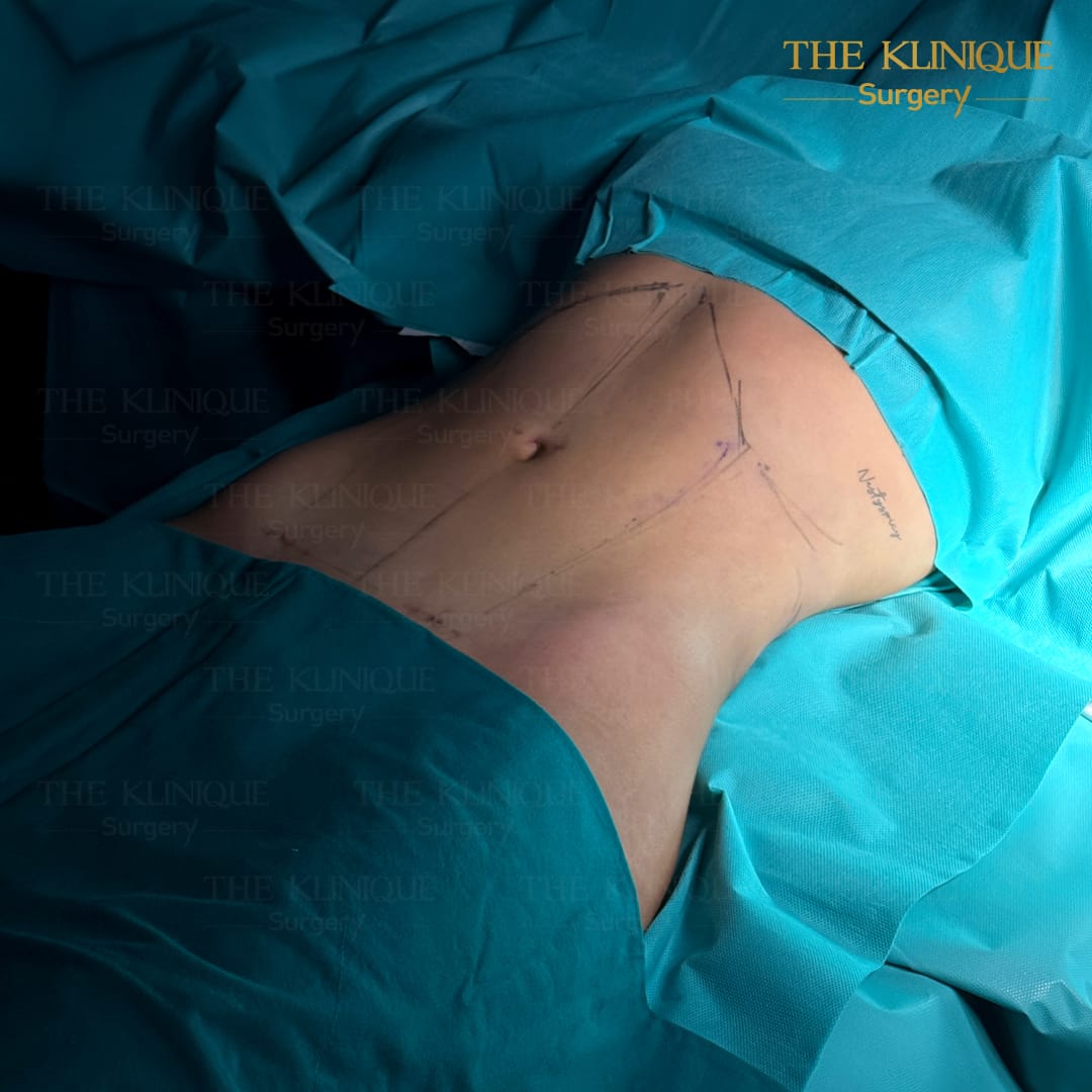 Liposuction-Review-Getting-NewBody-NestySpicy