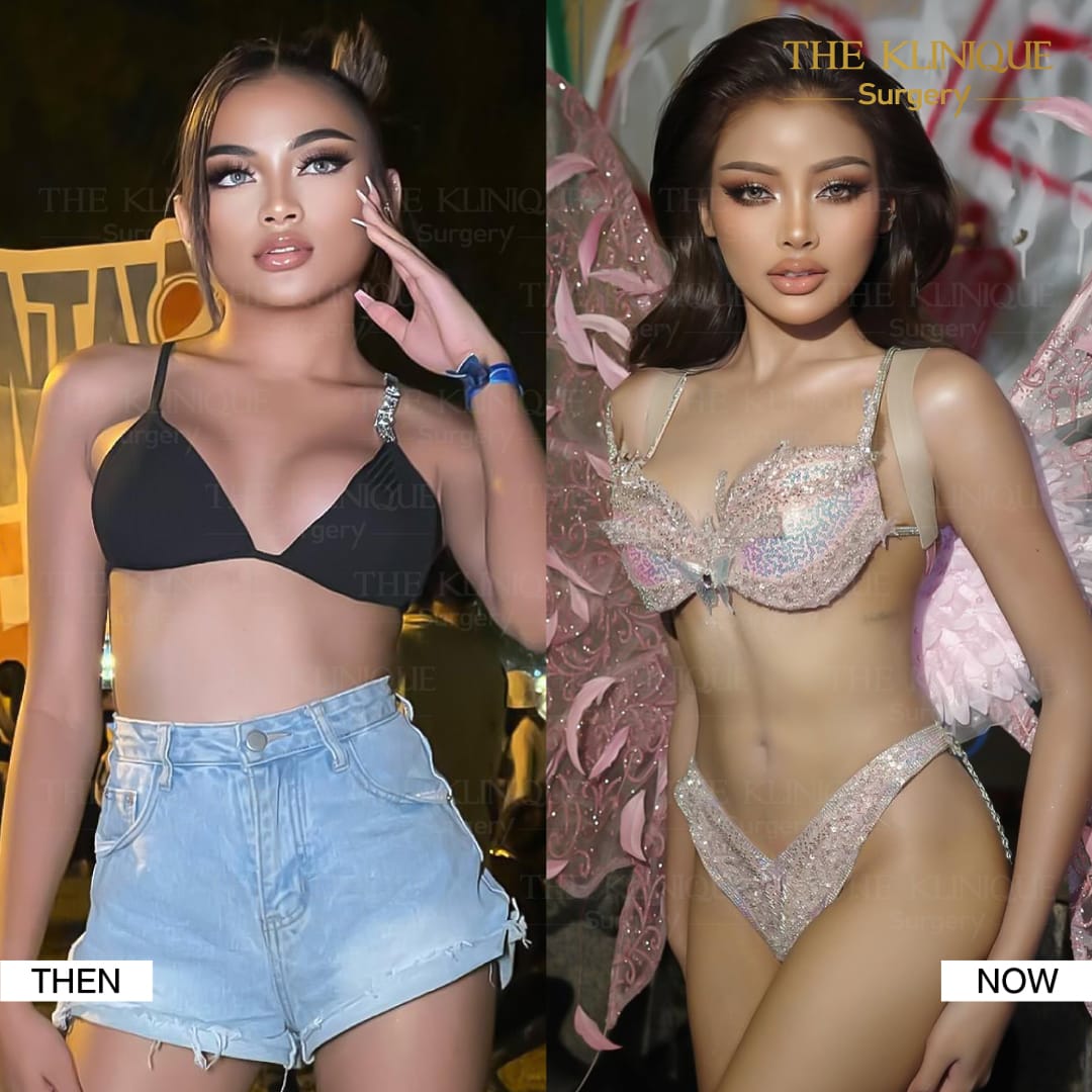 Liposuction-Review-Getting-NewBody-NestySpicy